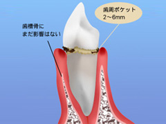 1.歯周病への入口