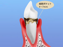 3.歯茎からの出血（中等度歯周炎）